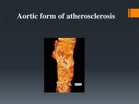 Ppt Introduction To Atherosclerosis Powerpoint Presentation Free