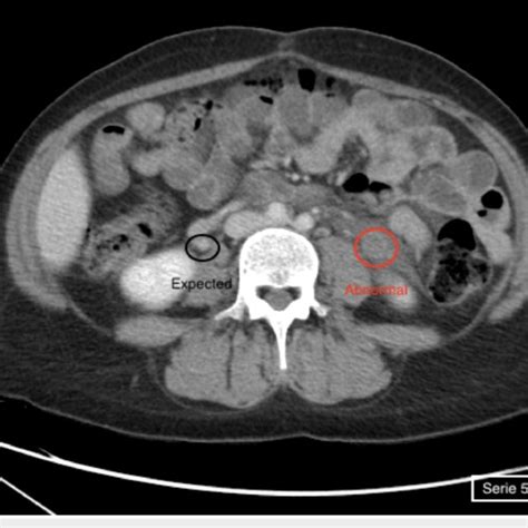 Ct Scan Axial Contrast Enhanced Ct Image Demonstrate Enlargement Of