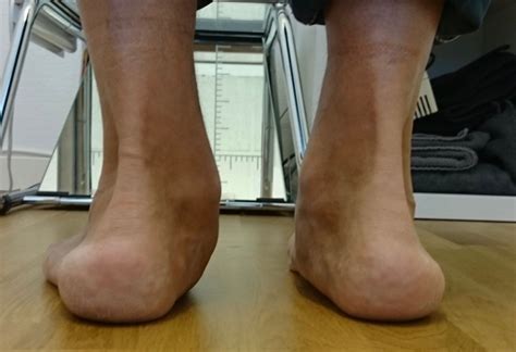 Achilles Tendinopathy Achilles Tendonitis Pronatos