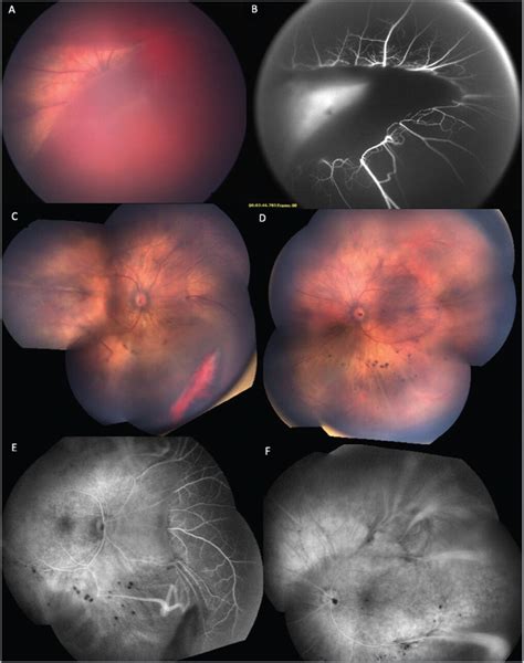 Vitreous Hemorrhage In Pediatric Patients With X Linked Retinoschisis Characteristics And