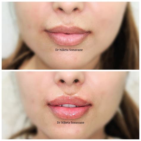 Lip Filler Cost Lokifoundry