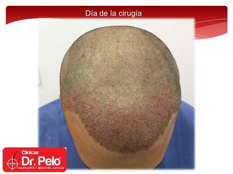 Reconstrucción de la cirugía anterior con aumento de densidad de la