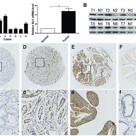 Expression Of Six In Prostate Cancer Tissues And Normal Prostate