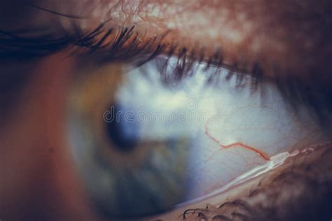 Macro Eyes With Bursting Red Blood Vessels Eyeball Covered With Blood