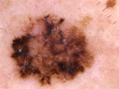 Abcdefg Of Melanoma Dr Maksym Breslavets