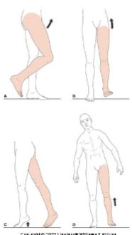 Abnormal Mobility Flashcards Quizlet