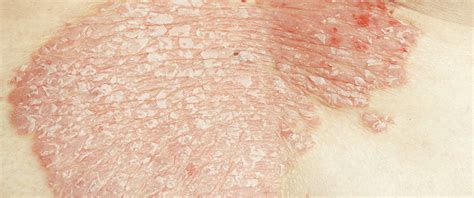 Skin Disease of the Week: Inverse Psoriasis - Elect Dermatology