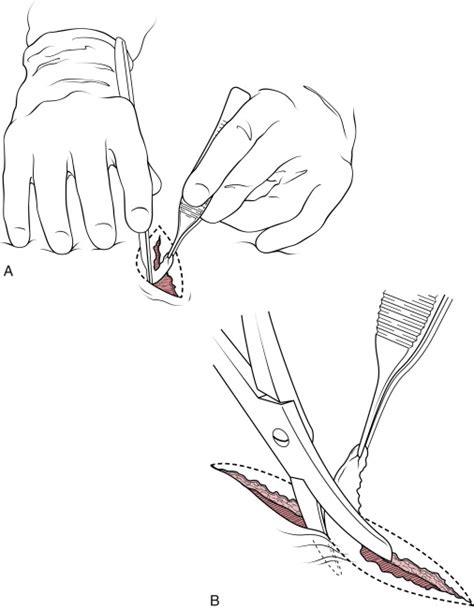 Suture Removal and Wound Aftercare | Anesthesia Key