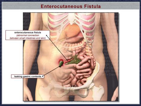 Enterocutaneous Fistula Trialquest Inc