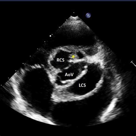 Two Dimensional Transthoracic Echocardiography In Parasternal