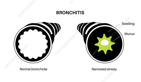 Bronchitis Lung Disease Illustration Stock Image F040 2792 Science Photo Library