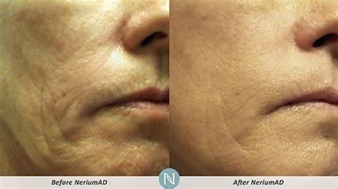 Before And After With Neriumhave Tried It Myselfit Works Wonders