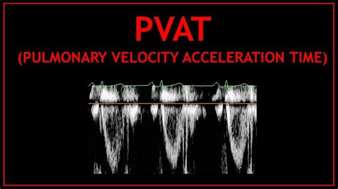 Pulmonary Velocity Acceleration Time PVAT Echocardiography YouTube