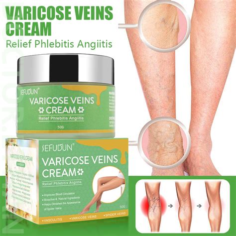 Varicose Vein Cream Remover Original Spider Vein Pain Killer Cream