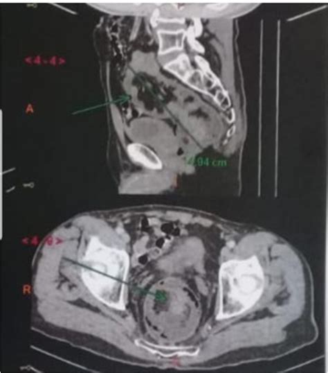 Scan Images Of The Abdomen Demonstrating The Colocolic Intussusception