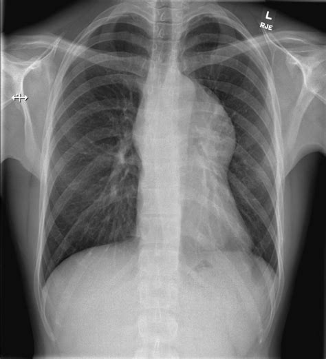 Mediastinal Germ Cell Tumor Image