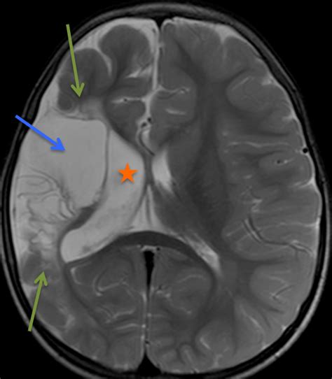 Closed Lip Schizencephaly Pacs