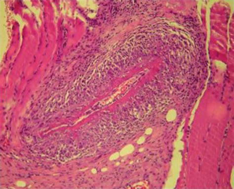 Muscle Biopsy Showing Evidence Of Fibrinoid Necrosis Of Two Download Scientific Diagram