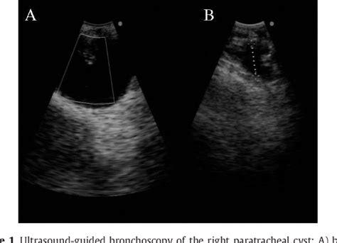 Figure From Drainage Of A Mediastinal Cyst By Endobronchial