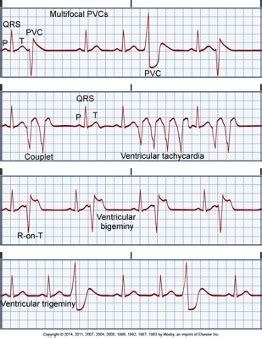 Ventricular Dysrhythmias Flashcards Quizlet