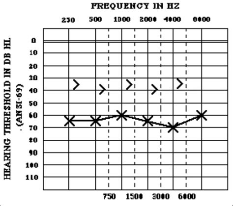 Mixed Hearing Loss | Download Scientific Diagram