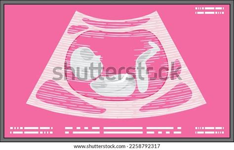 Ultrasound Picture Fetus Illustration Stock Vector (Royalty Free ...