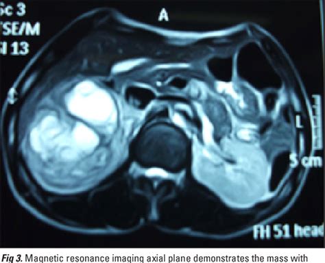 A Case Of Clinically Silent Giant Right Pheochromocytoma And Review Of Literature Semantic