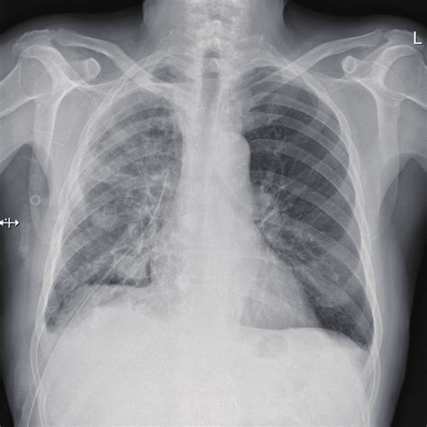 Posterior Anterior Chest X Ray