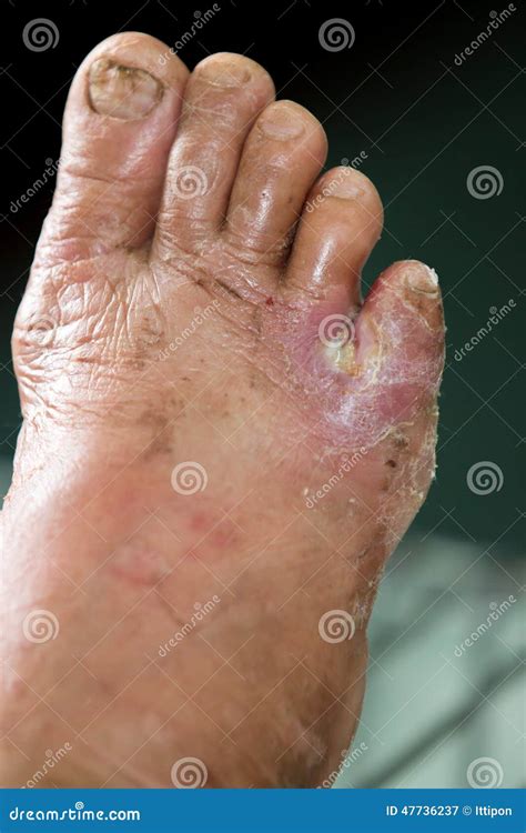 Wound Of Diabetic Foot Stock Image Image Of Heal Burn 47736237