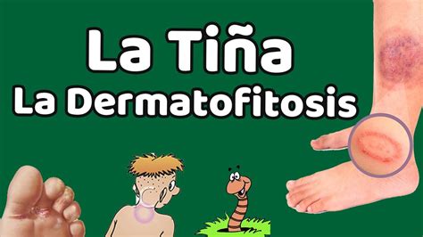 LA DERMATOFITOSIS Causas signos y síntomas diagnóstico y tratamiento