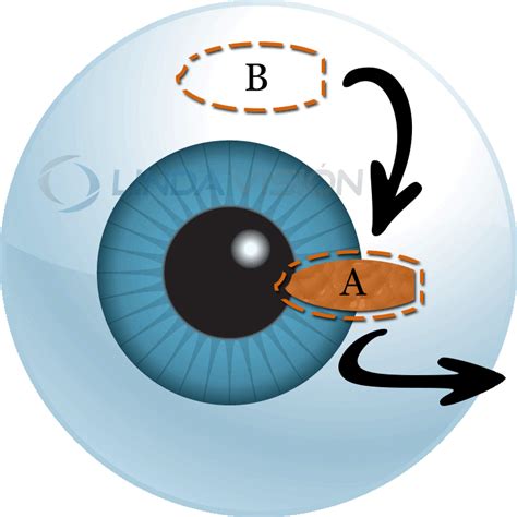 Pterygium Surgery Monterey Park, CA - Pterygium Treatment