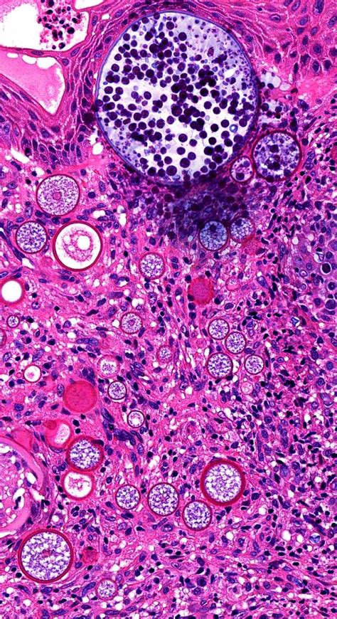 Pathology Of Rhinosporidiosis Medical Art Histology Slides Art