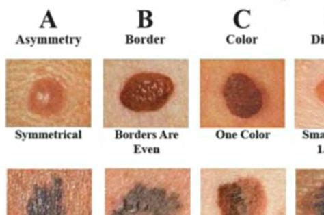 Macules Vs Papules Primary Lesions Pediatrics Pinterest Medical