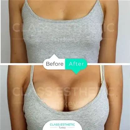 Breast Augmentation Surgery In Istanbul Turkey