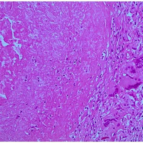 Non Specific Subcutaneous Necrotic Mass Left Half Of Picture And