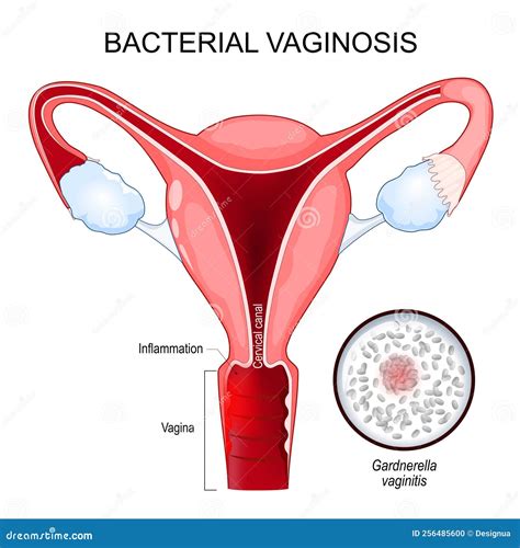 Bacterial Vaginosis