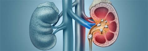 Methods of treatment to remove kidney stones - Island Hospital