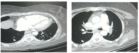 Pulmonary computed tomography angiography of case 1. | Download ...