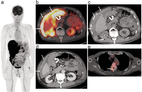 Figure From Malignant Peritoneal Mesothelioma Features Shown By Fdg