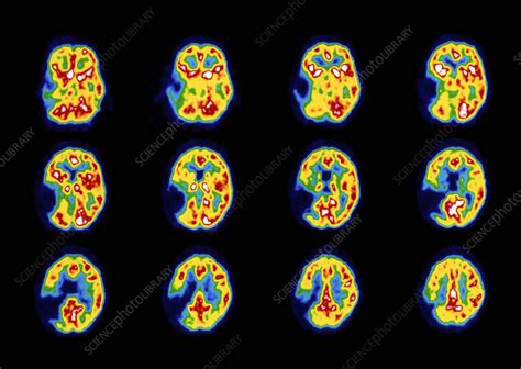 Colour PET Scans Of The Brain Of A Stroke Patient Stock Image M136