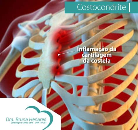 Costocondrite Dra Bruna Henares