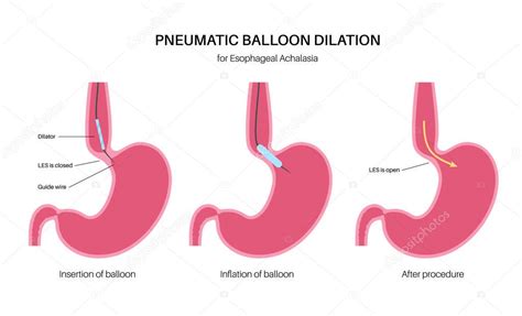 Dilataci N Neum Tica Endosc Pica Endoscopia Superior Procedimiento