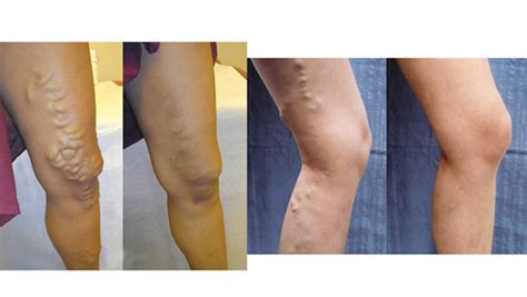 Varicose Veins Treatment A Qanda With Ucsf Interventional Radiologists