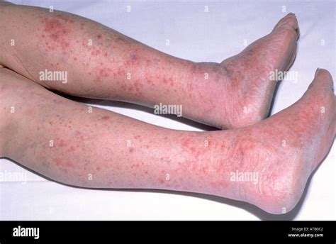 Purpura Meningitis Fotos Und Bildmaterial In Hoher Auflösung Alamy