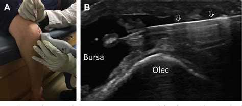 Figure From Ultrasound Guided Elbow Procedures Semantic Scholar