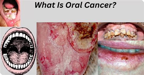 4 Types Of Oral Cancer Symptoms Causes And Treatment Perfect Latest