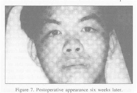 Figure 2 from Management Of Zygomatico-Orbital Fractures Using Rigid ...