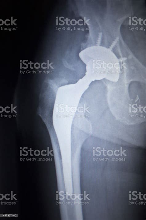 Xray Scan Image Of Hip Joint Replacement Orthopedic Implant Stock Photo