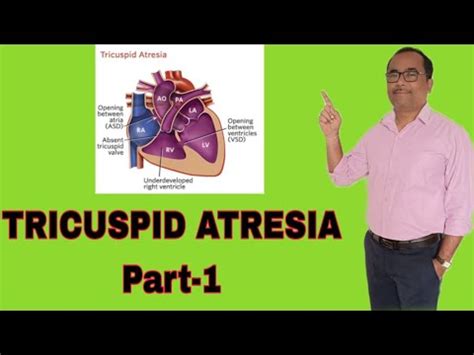 TRICUSPID ATRESIA PART 1 YouTube