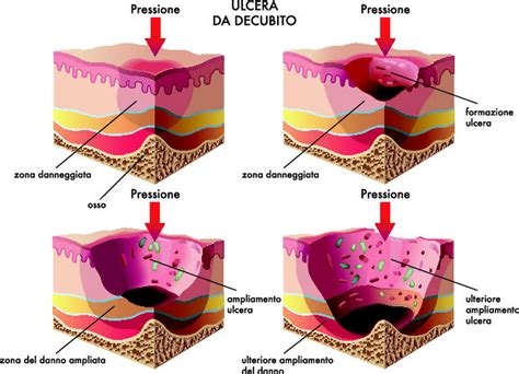 Piaghe Da Decubito Stadi Cura